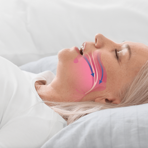 Sleep Apnea